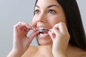 invisalign invisible-braces for adults